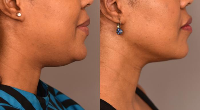 Before & After Neck Liposuction / Chin Liposuction  Case 226 View #3 View in New York, NY