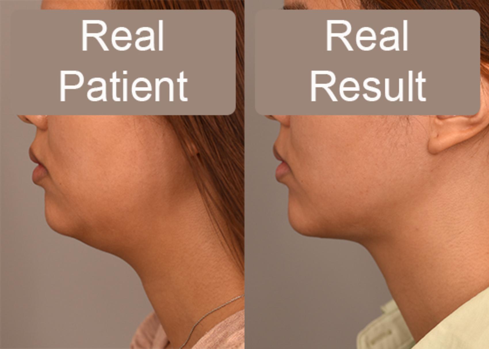 Before & After Neck Liposuction / Chin Liposuction  Case 243 View #1 View in New York, NY
