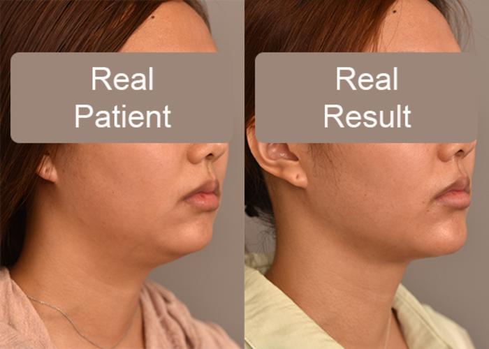 Before & After Neck Liposuction / Chin Liposuction  Case 243 View #2 View in New York, NY