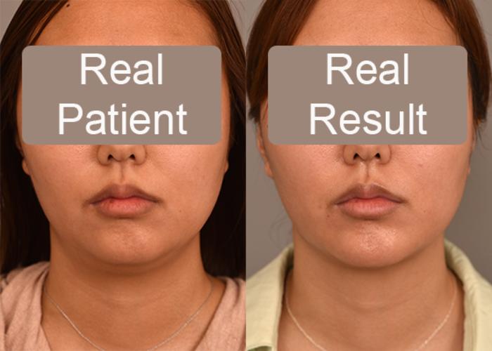 Before & After Neck Liposuction / Chin Liposuction  Case 243 View #3 View in New York, NY