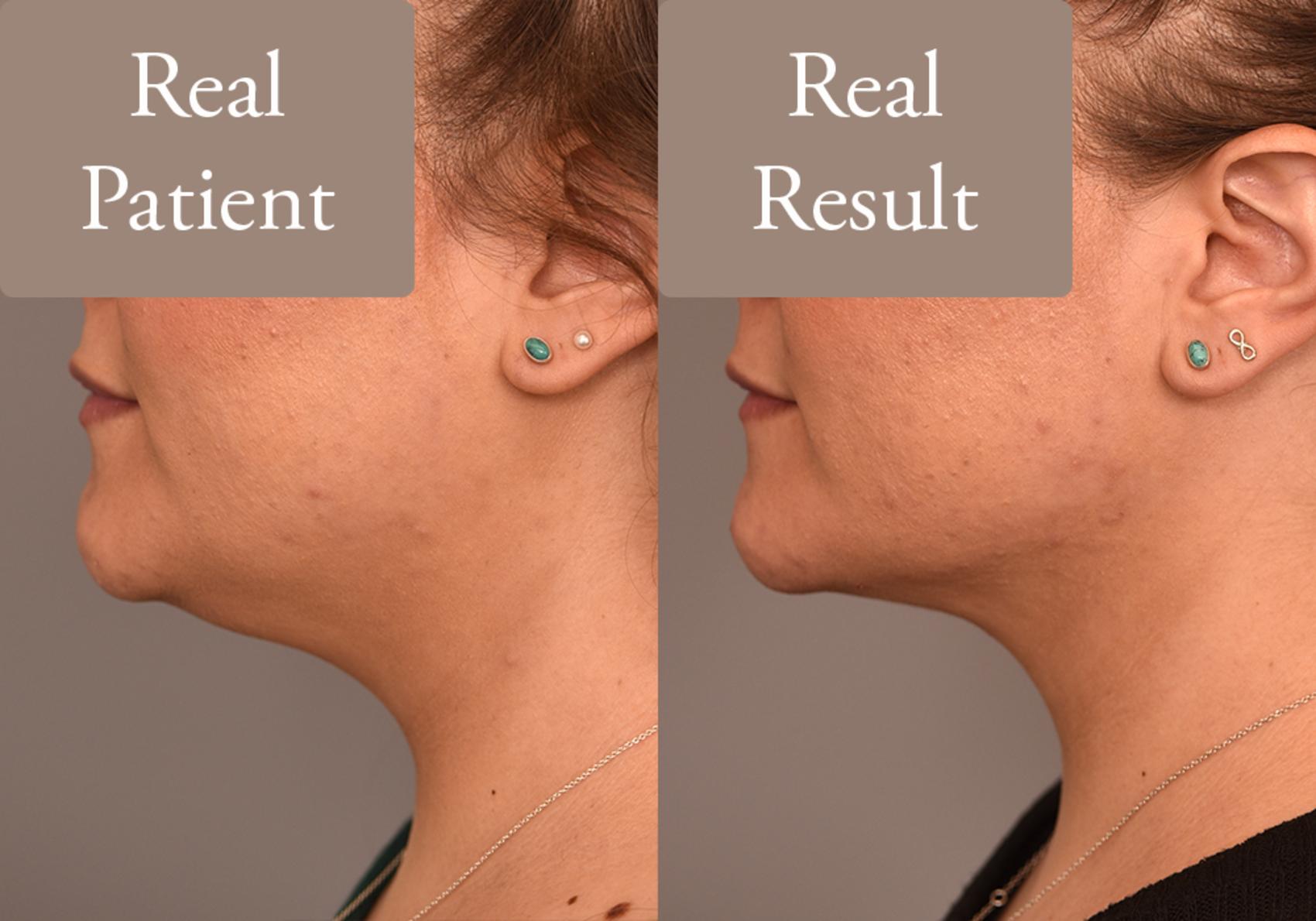 Before & After Neck Liposuction / Chin Liposuction  Case 244 View #1 View in New York, NY