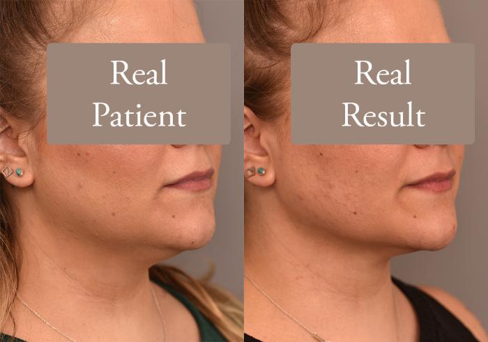 Before & After Neck Liposuction / Chin Liposuction  Case 244 View #2 View in New York, NY