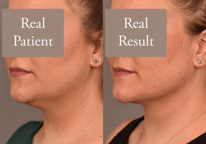 Before & After Neck Liposuction / Chin Liposuction  Case 244 View #3 View in New York, NY