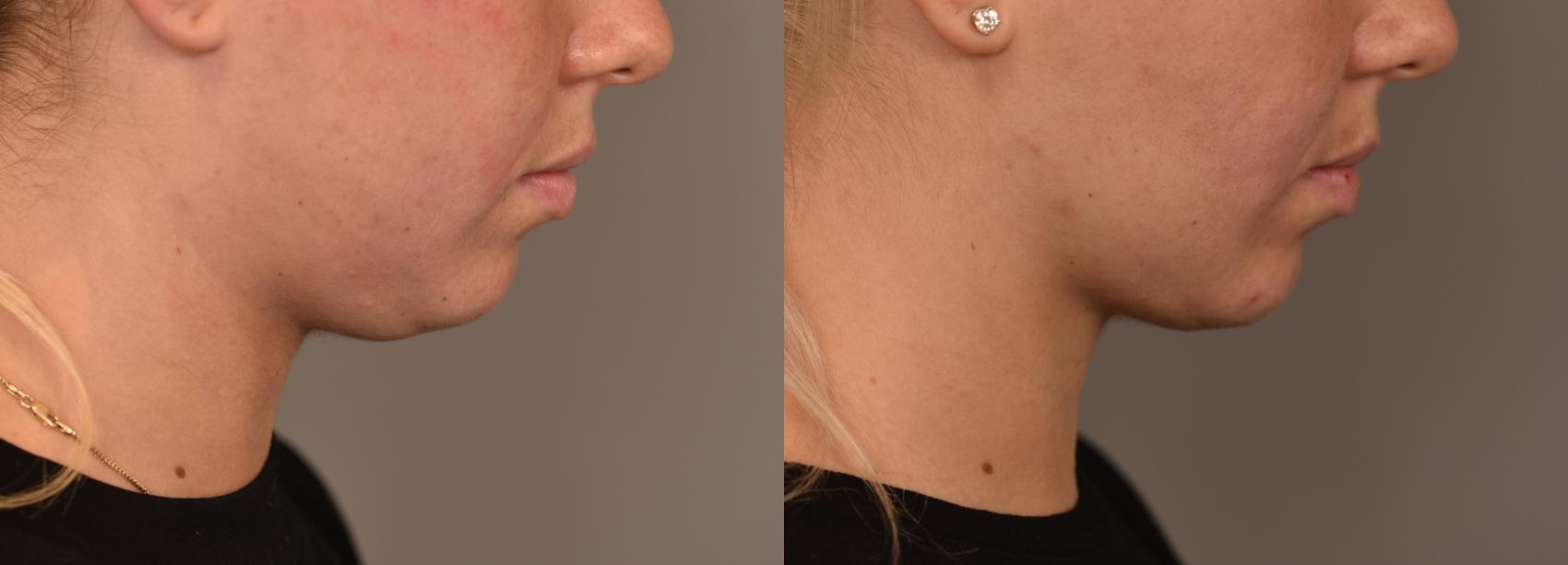 Before & After Cheek Liposuction Case 251 View #1 View in New York, NY