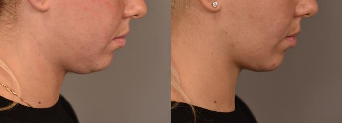 Before & After Buccal Fat Removal Case 251 View #1 View in New York, NY