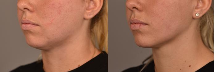 Before & After Neck Liposuction / Chin Liposuction  Case 251 View #2 View in New York, NY
