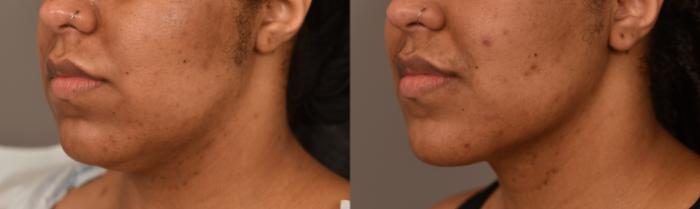 Before & After Neck Liposuction / Chin Liposuction  Case 252 View #1 View in New York, NY