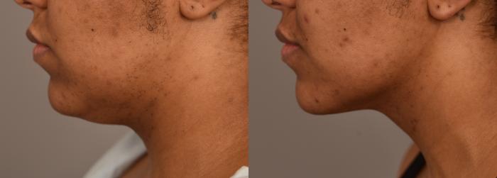 Before & After Neck Liposuction / Chin Liposuction  Case 252 View #2 View in New York, NY