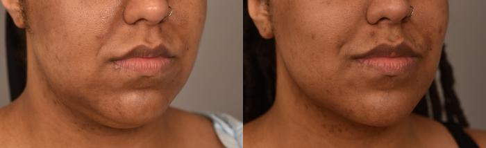 Before & After Neck Lift (Traditional) Case 252 View #3 View in New York, NY