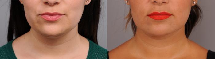 Before & After Neck Liposuction / Chin Liposuction  Case 257 Front View in New York, NY