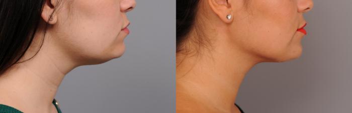 Before & After Neck Liposuction / Chin Liposuction  Case 257 Left Side View in New York, NY