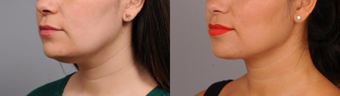 Before & After Neck Liposuction / Chin Liposuction  Case 257 Right Oblique View in New York, NY