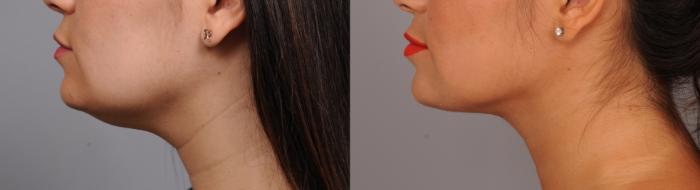 Before & After Neck Liposuction / Chin Liposuction  Case 257 Right Side View in New York, NY