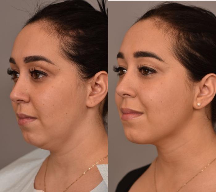 Before & After Neck Liposuction / Chin Liposuction  Case 266 Left Oblique View in New York, NY