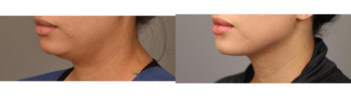 Before & After Neck Liposuction / Chin Liposuction  Case 268 Left Oblique View in New York, NY