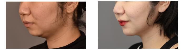 Before & After Neck Liposuction / Chin Liposuction  Case 270 Left Oblique View in New York, NY