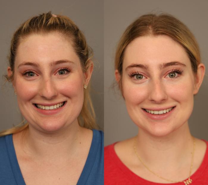 Before & After Neck Liposuction / Chin Liposuction  Case 286 Front View in New York, NY