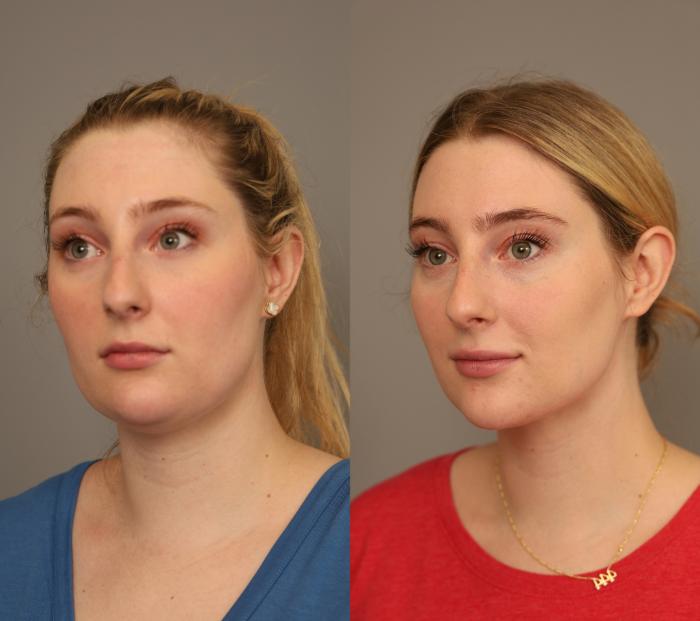 Before & After Neck Liposuction / Chin Liposuction  Case 286 Left Oblique View in New York, NY