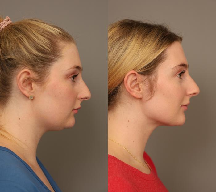 Before & After Neck Liposuction / Chin Liposuction  Case 286 Left Side View in New York, NY