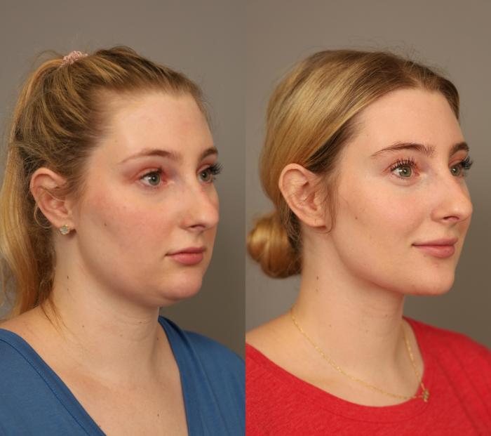 Before & After Neck Liposuction / Chin Liposuction  Case 286 Right Oblique View in New York, NY