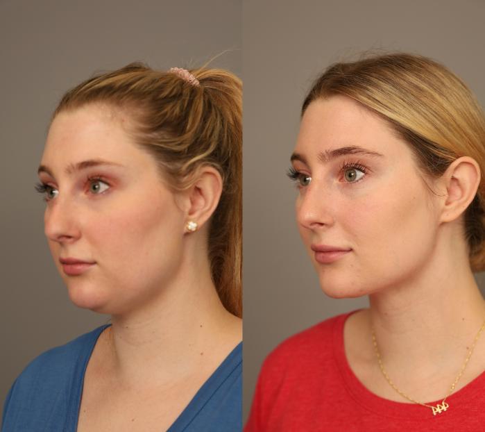 Before & After Neck Liposuction / Chin Liposuction  Case 286 Right Side View in New York, NY