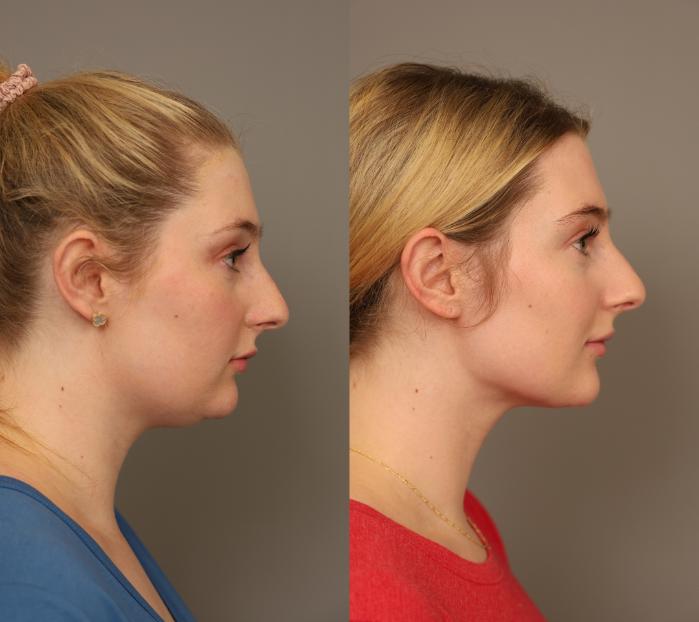 Before & After Neck Liposuction / Chin Liposuction  Case 287 Left Side View in New York, NY