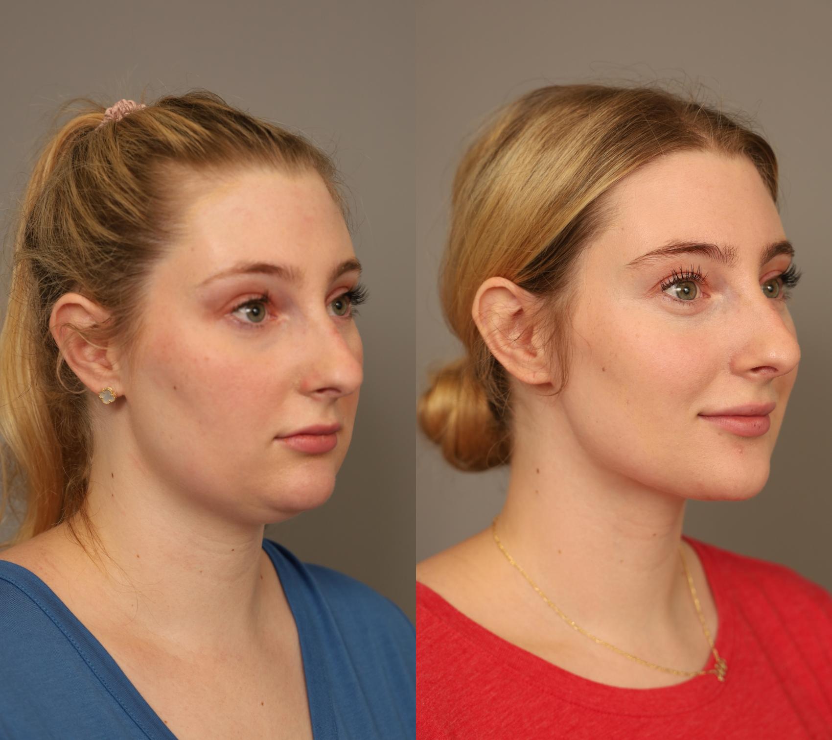 Before & After Neck Liposuction / Chin Liposuction  Case 289 Right Oblique View in New York, NY