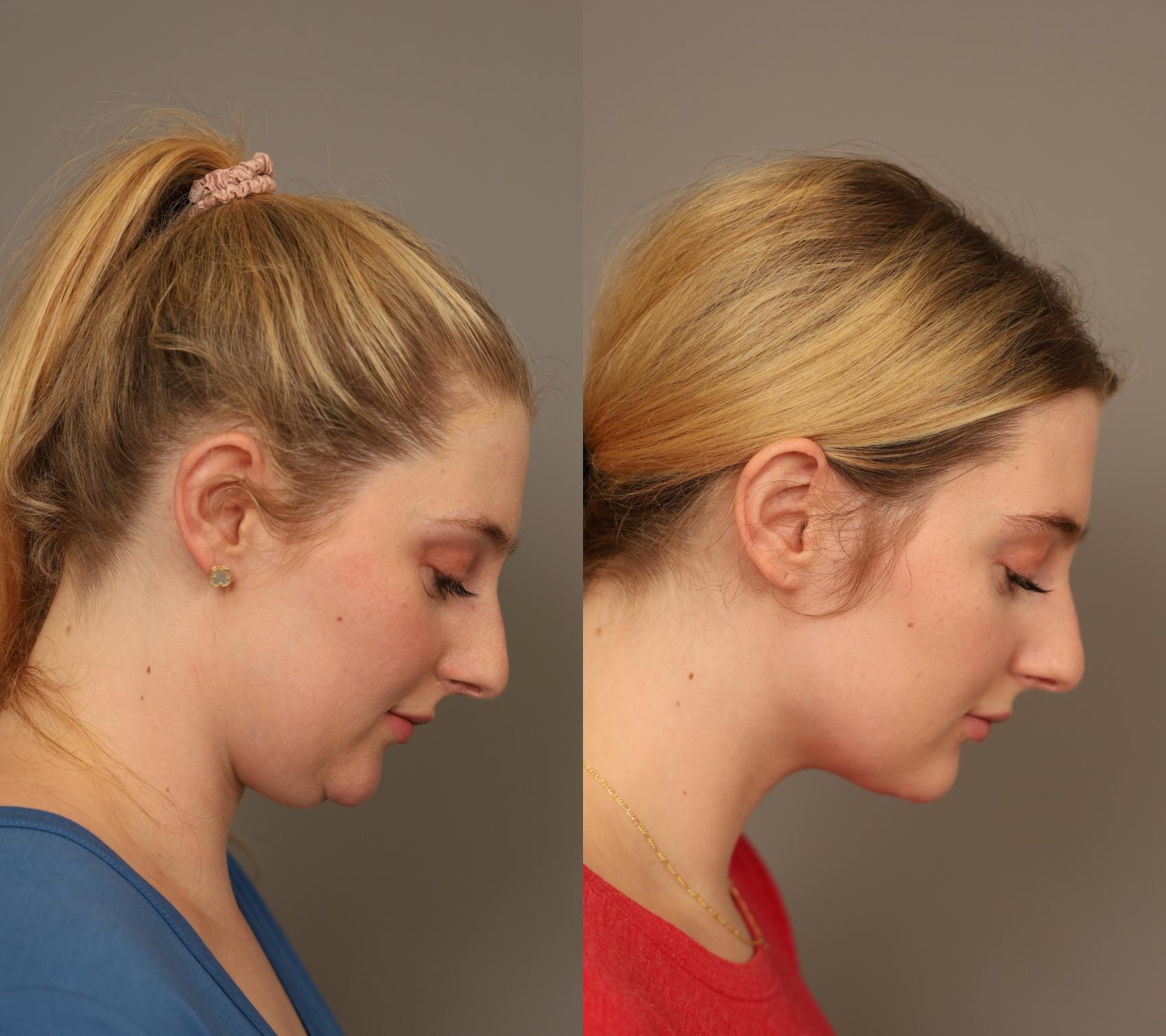 Before & After Neck Liposuction / Chin Liposuction  Case 290 Downward Angle View in New York, NY