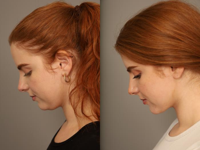 Before & After Neck Liposuction / Chin Liposuction  Case 303 Front View in New York, NY