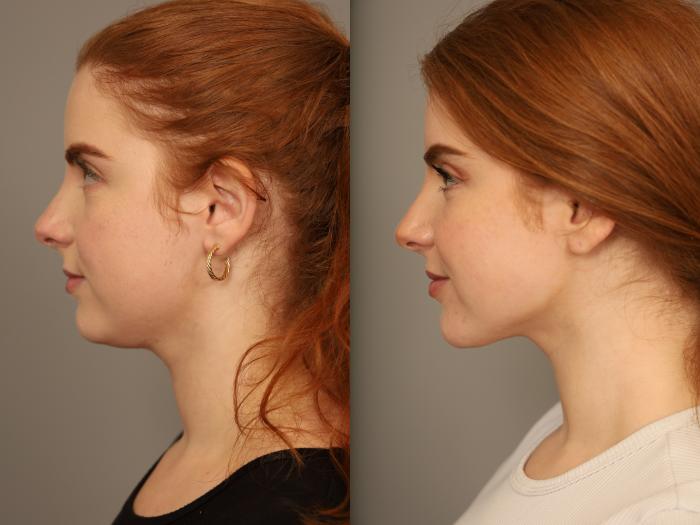 Before & After Neck Liposuction / Chin Liposuction  Case 303 Left Oblique View in New York, NY