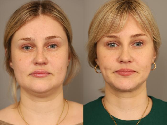 Before & After Neck Liposuction / Chin Liposuction  Case 331 Front View in New York, NY