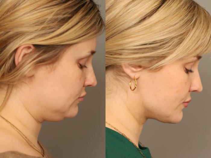 Before & After Neck Liposuction / Chin Liposuction  Case 331 Left Downward  View in New York, NY