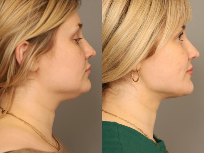 Before & After Neck Liposuction / Chin Liposuction  Case 331 Left Side  View in New York, NY