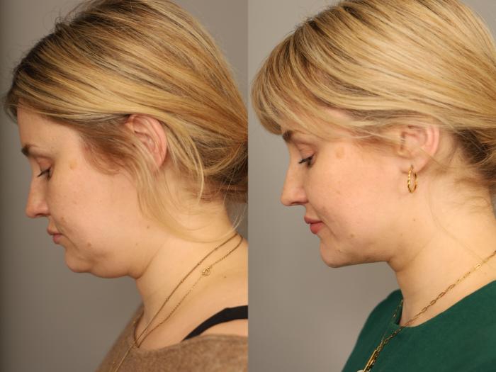 Before & After Neck Liposuction / Chin Liposuction  Case 331 Right Down View in New York, NY