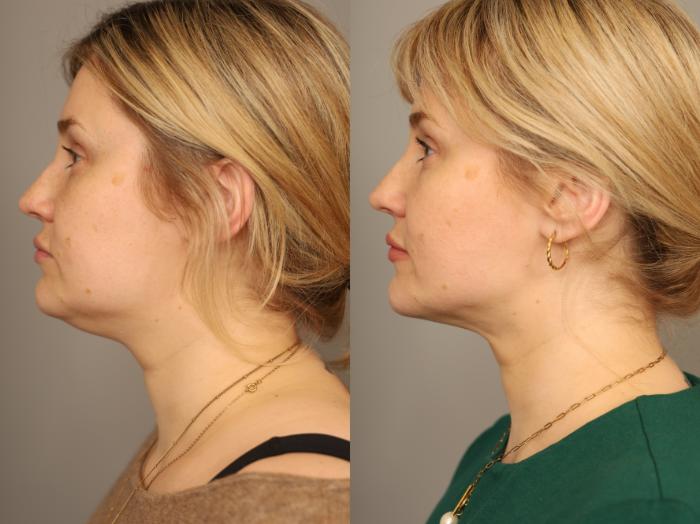 Before & After Neck Liposuction / Chin Liposuction  Case 331 Right Side View in New York, NY
