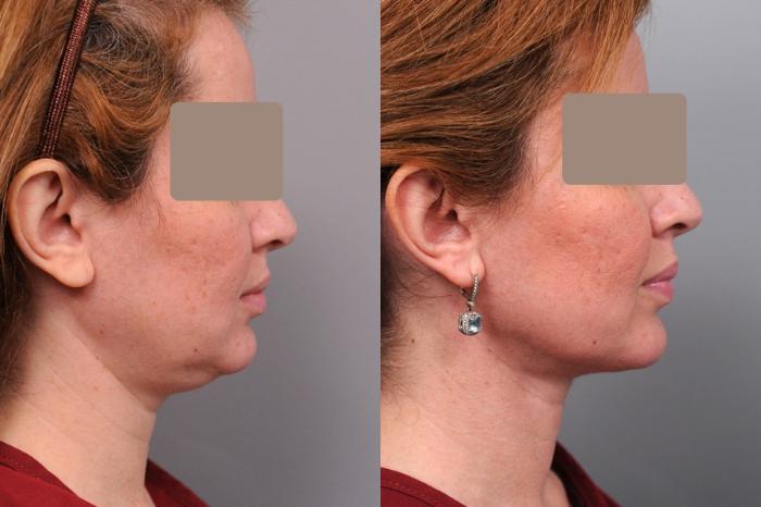 Before & After Neck Liposuction / Chin Liposuction  Case 37 View #1 View in New York, NY