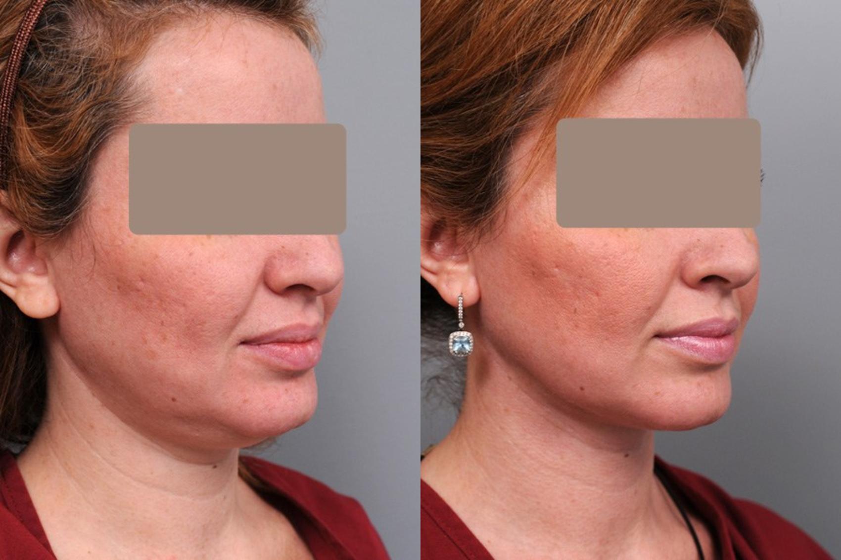 Smartlipo™ Liposuction Before And After Photos Patient 37 Nyc Dr Thomas Sterry 