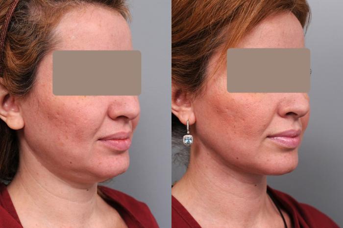 Before & After Neck Liposuction / Chin Liposuction  Case 37 View #2 View in New York, NY