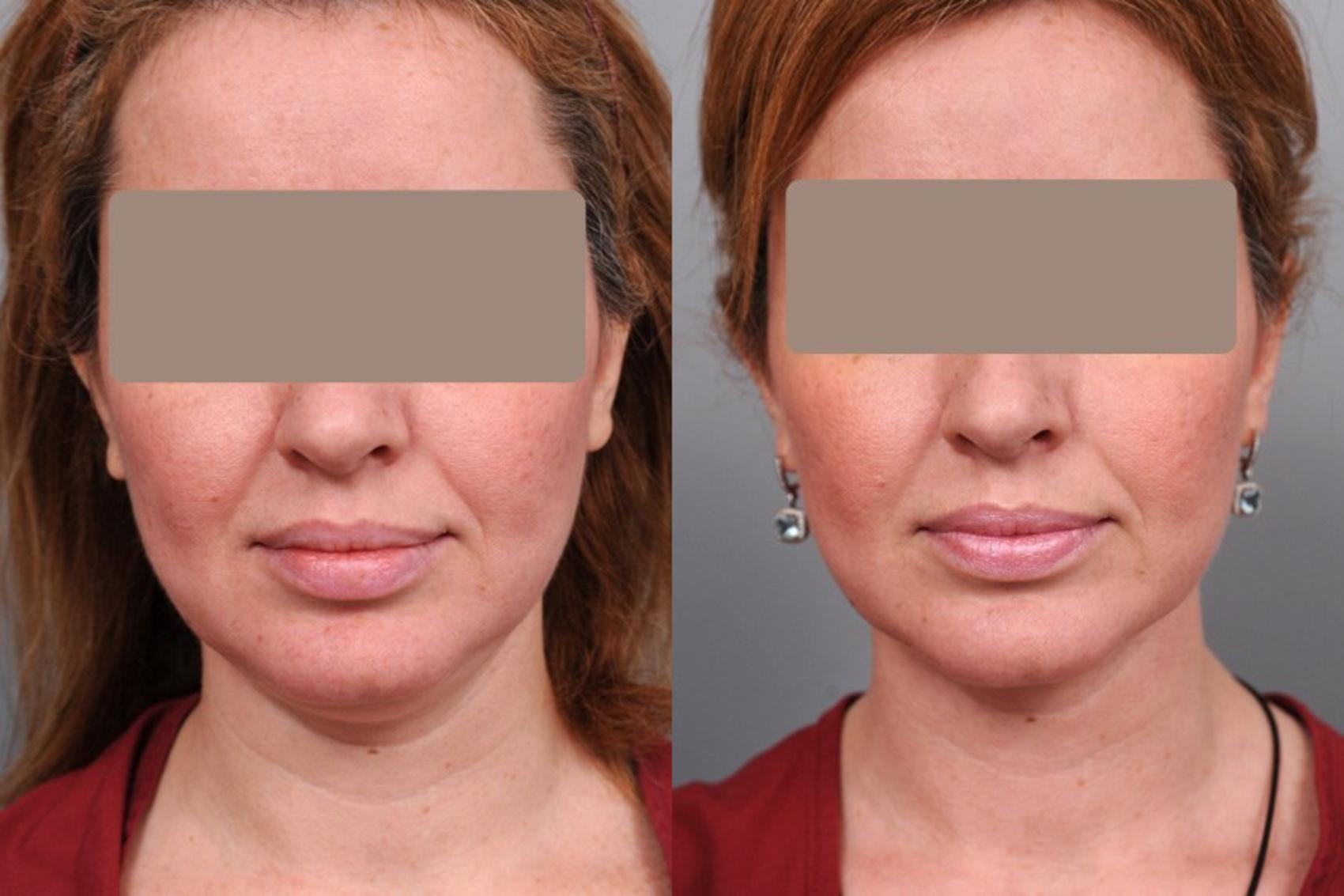 Smartlipo™ Liposuction Before And After Photos Patient 37 Nyc Dr Thomas Sterry 