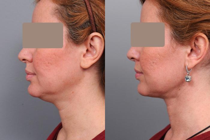 Before & After Neck Liposuction / Chin Liposuction  Case 37 View #4 View in New York, NY