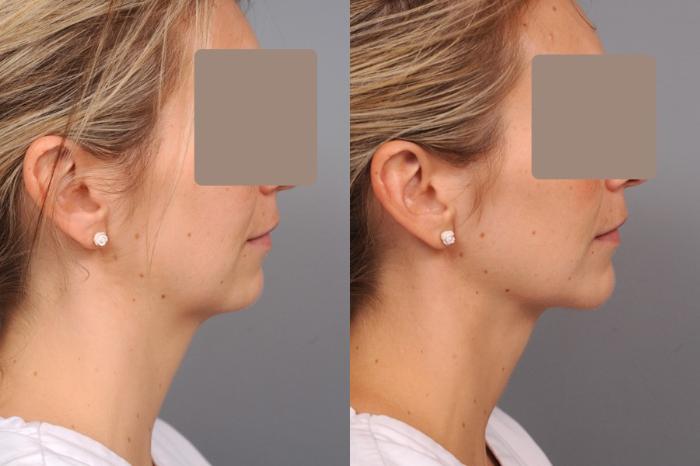 Before & After Chin Implant Case 46 View #1 View in New York, NY