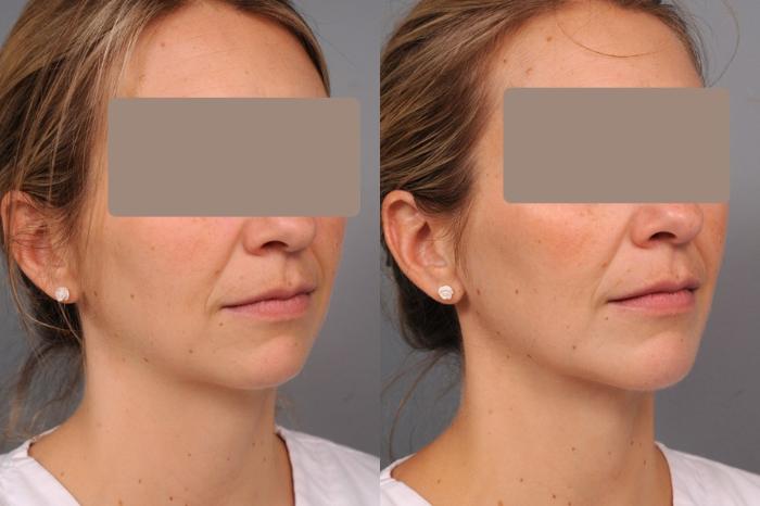 Before & After Neck Liposuction / Chin Liposuction  Case 46 View #2 View in New York, NY
