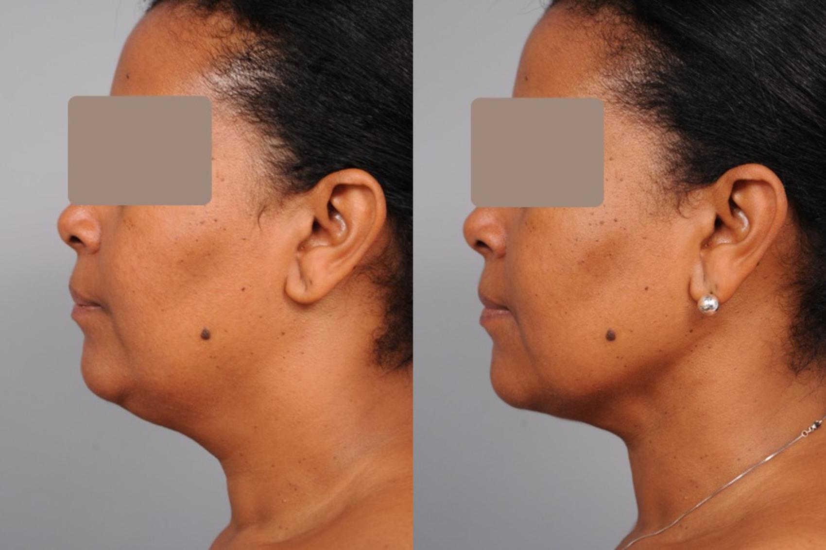 Before & After Neck Liposuction / Chin Liposuction  Case 50 View #1 View in New York, NY