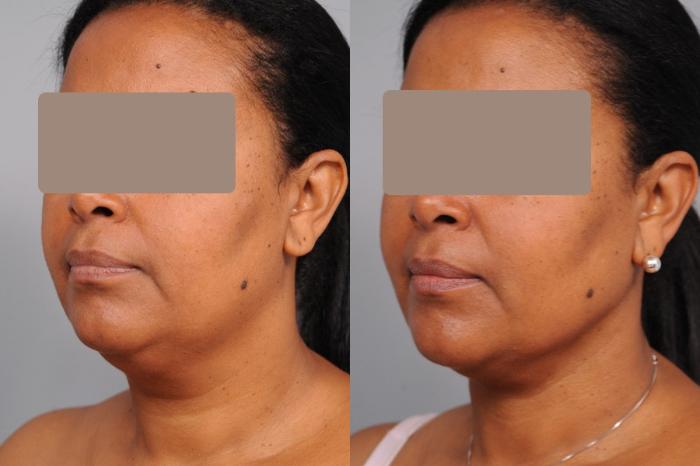 Before & After Neck Liposuction / Chin Liposuction  Case 50 View #2 View in New York, NY