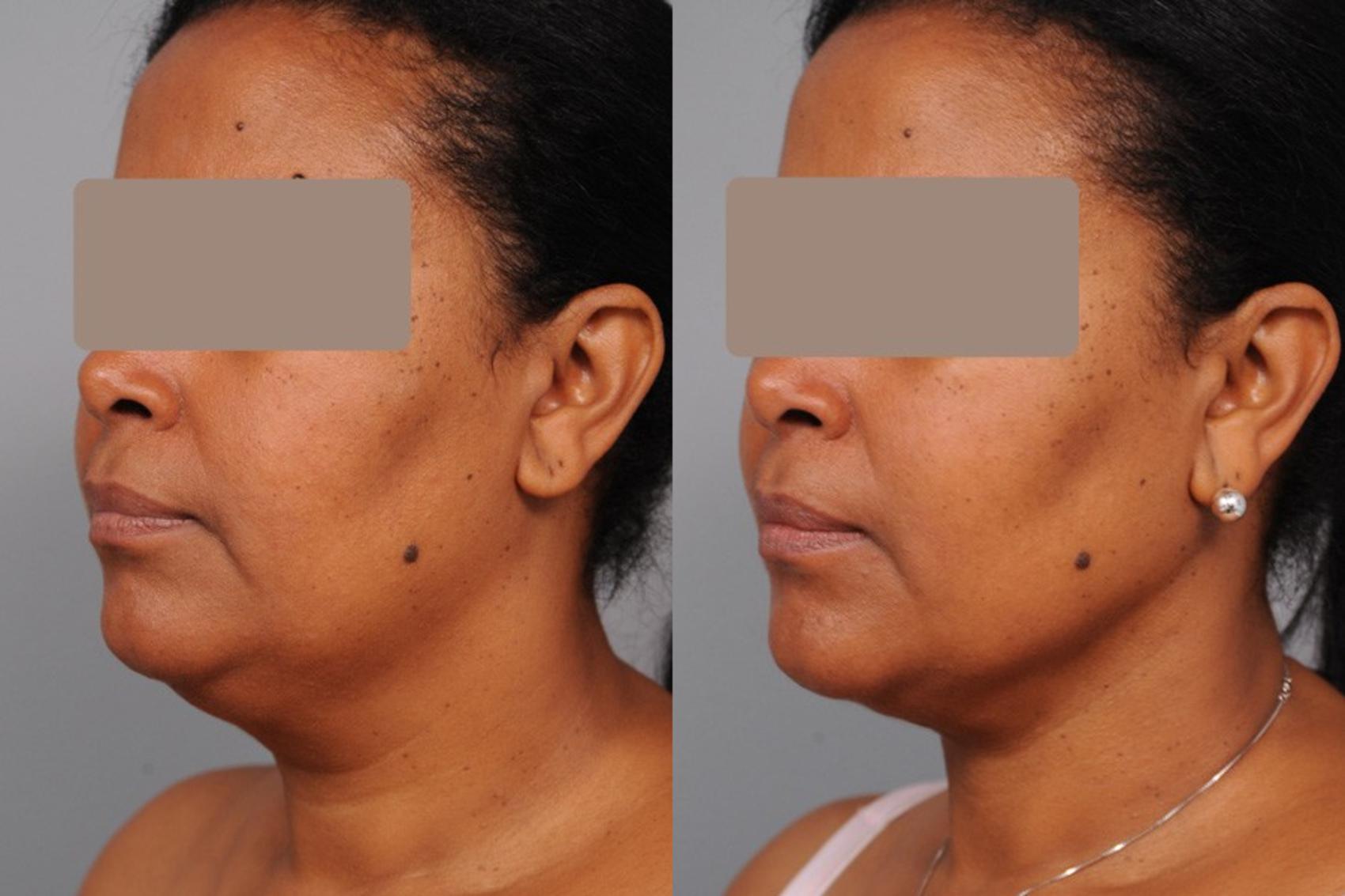 Smartlipo™ Neck Liposuction in New York Dr. Sterry