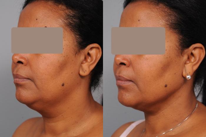 Before & After Neck Liposuction / Chin Liposuction  Case 50 View #3 View in New York, NY