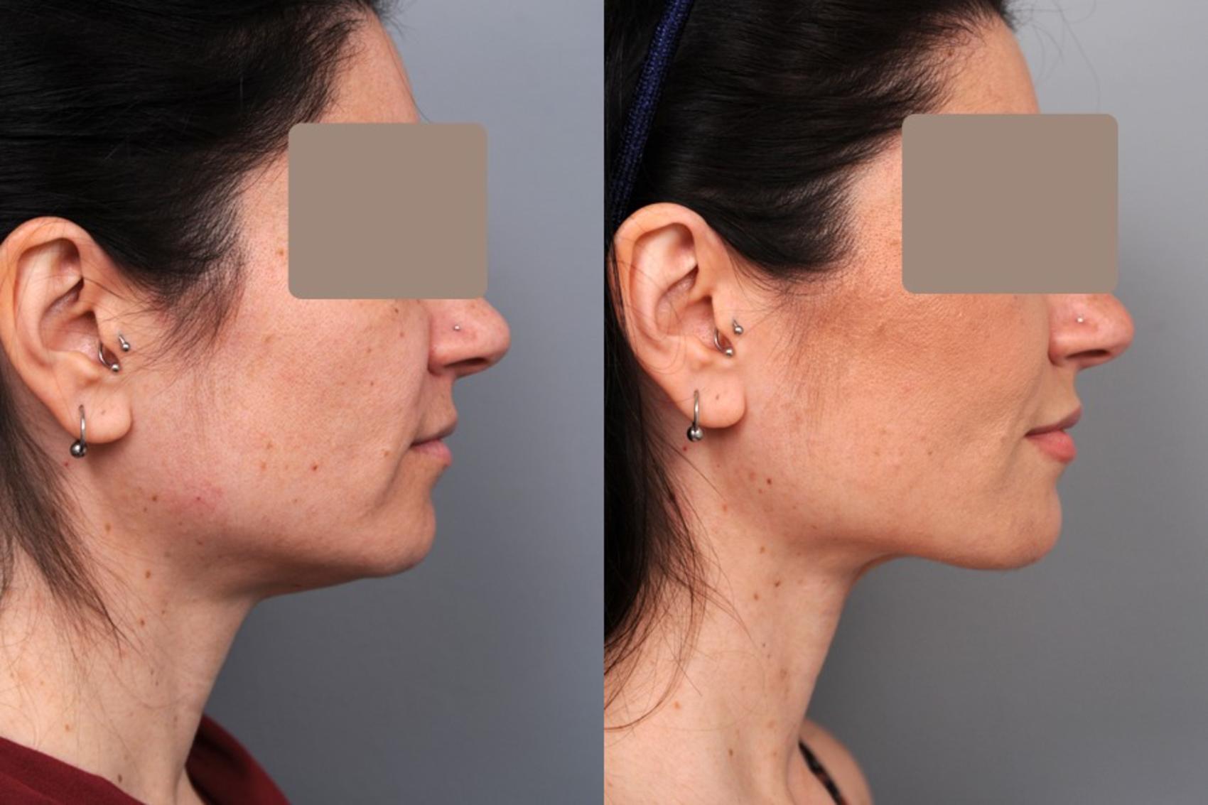 Before & After Neck Liposuction / Chin Liposuction  Case 51 View #1 View in New York, NY
