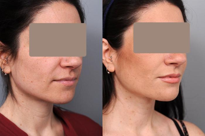 Before & After Neck Liposuction / Chin Liposuction  Case 51 View #2 View in New York, NY