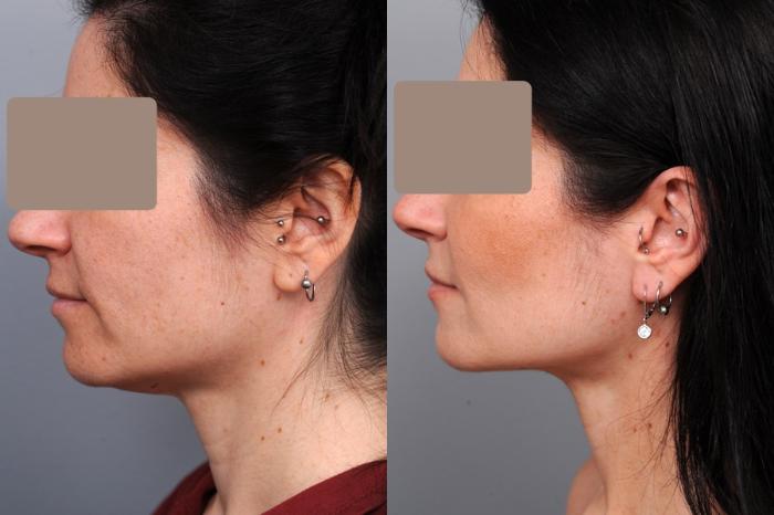 Before & After Neck Liposuction / Chin Liposuction  Case 51 View #3 View in New York, NY