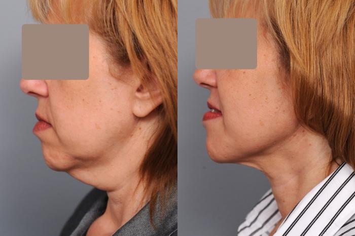 Before & After Neck Liposuction / Chin Liposuction  Case 52 View #1 View in New York, NY